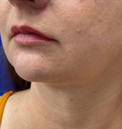 Neck Liposuction case #3914