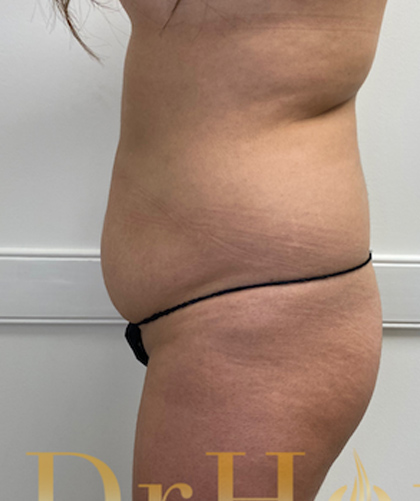 Liposuction case #3734