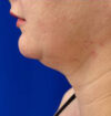 Neck Liposuction case #3914