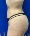 Liposuction case #3734