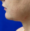 Neck Liposuction case #3914