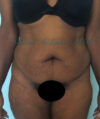 Liposuction case #3577