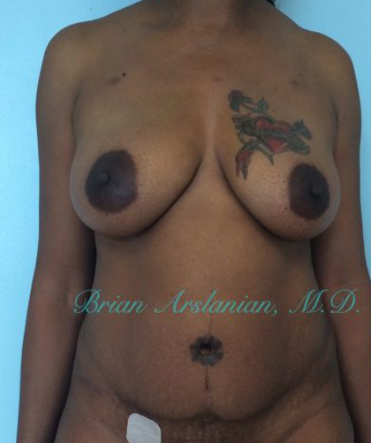 Breast Augmentation case #2508