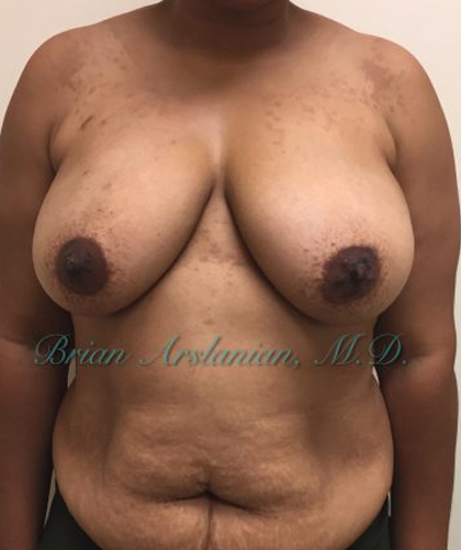 | Arslanian Plastic Surgery Atlanta Before & After Plastic Surgery Results | facial procedure