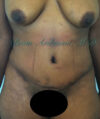 Liposuction case #3577