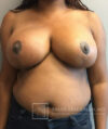 Breast Reduction case #2890