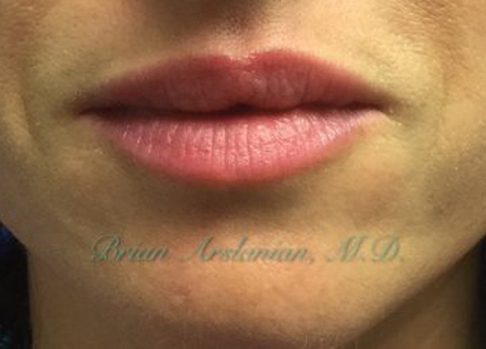 Fillers case #3470