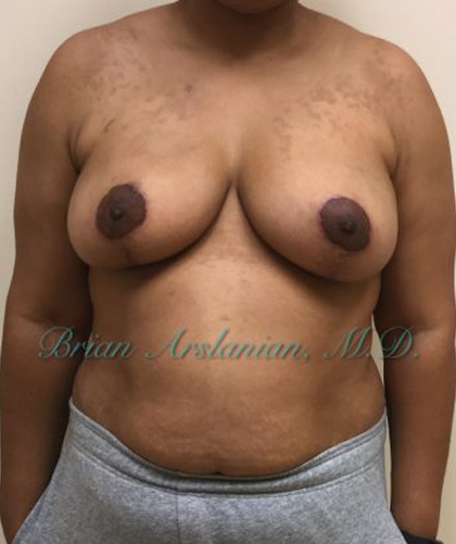 | Arslanian Plastic Surgery Atlanta Before & After Plastic Surgery Results | body procedure