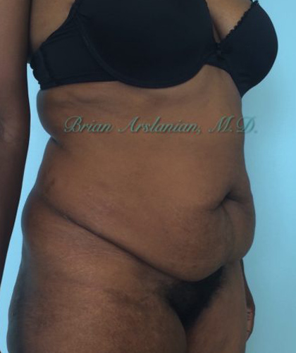 Liposuction case #3577