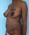 Breast Augmentation case #2508