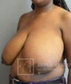 Breast Reduction case #2890