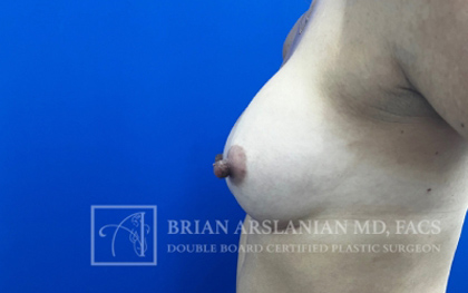 Breast Augmentation case #2747