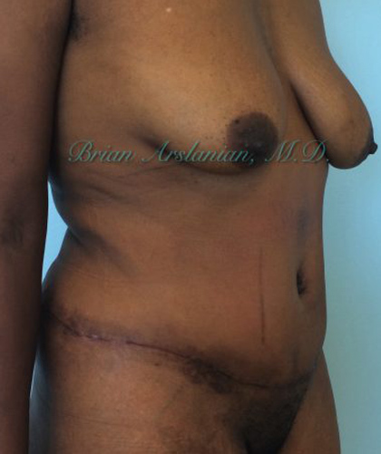 Liposuction case #3577