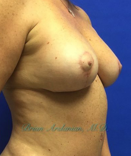 Breast Implants and Lift case #2991