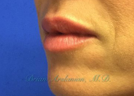 Fillers case #3470