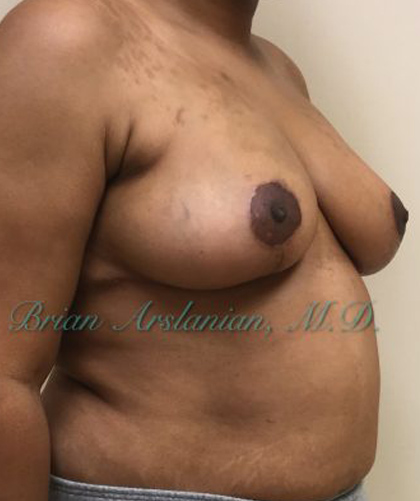 Breast Lift case #2829