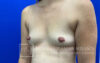 Breast Augmentation case #2747