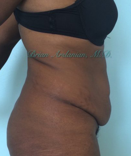 Liposuction case #3577