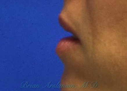 Fillers case #3470