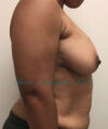 Breast Lift case #2829