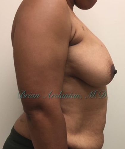 Breast Lift case #2829