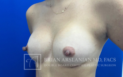 Breast Augmentation case #2747