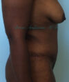 Liposuction case #3577