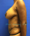 Breast Augmentation case #2508