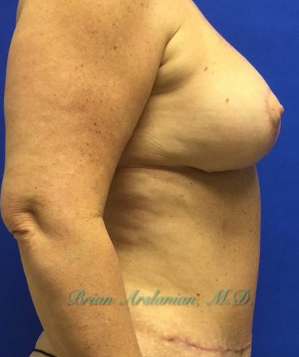 Breast Implants and Lift case #2991