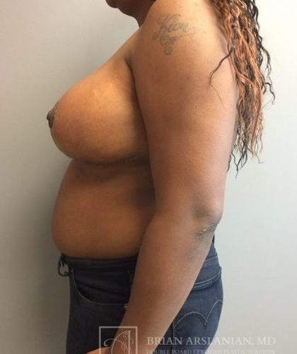 Breast Reduction case #2890