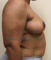 Breast Lift case #2829