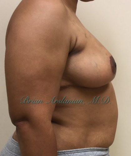 Breast Lift case #2829