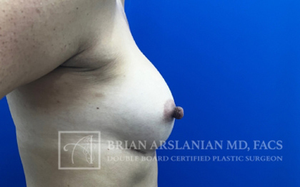 Breast Augmentation case #2747