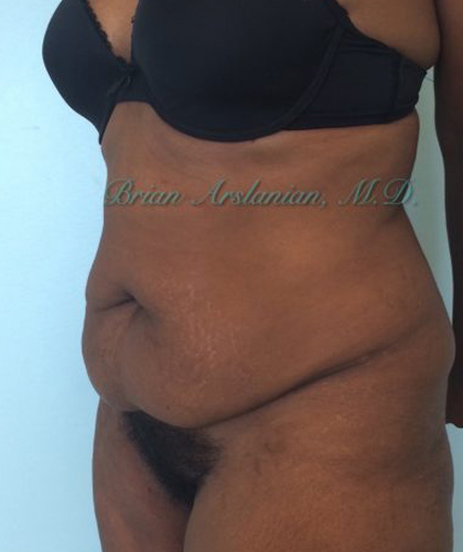 Liposuction case #3577