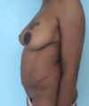 Breast Augmentation case #2508