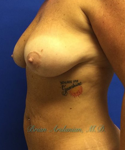 Breast Implants and Lift case #2991