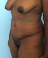 Liposuction case #3577