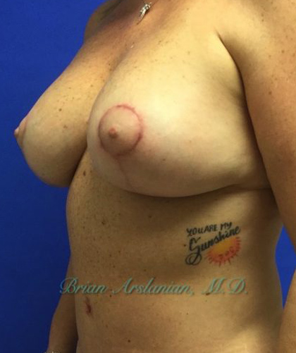 Breast Implants and Lift case #2991