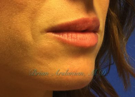 Fillers case #3470