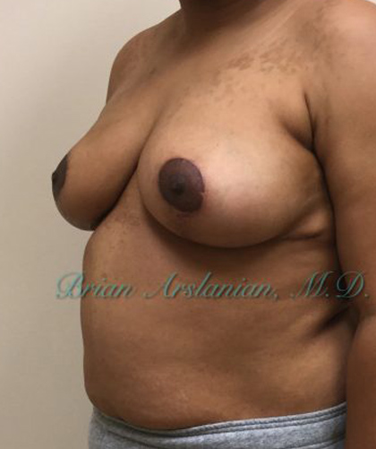 Breast Lift case #2829