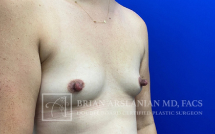 Breast Augmentation case #2747