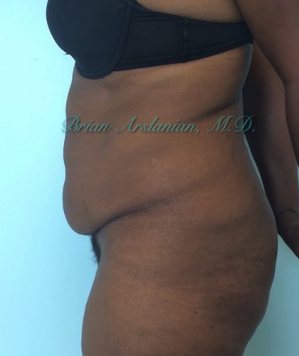 Liposuction case #3577