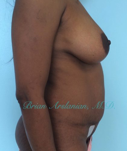 Breast Augmentation case #2508