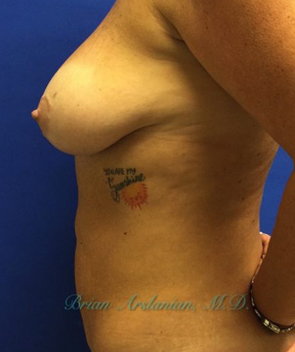 Breast Implants and Lift case #2991