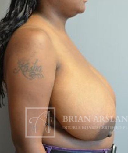 Breast Reduction case #2890