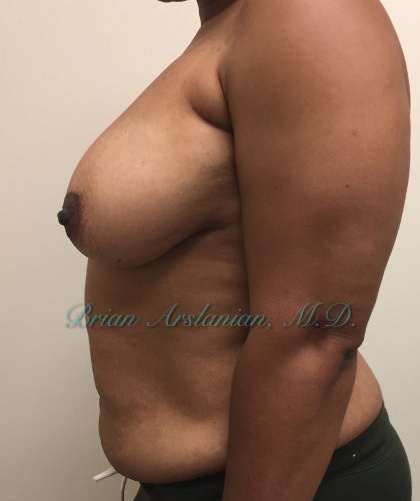 Breast Lift case #2829