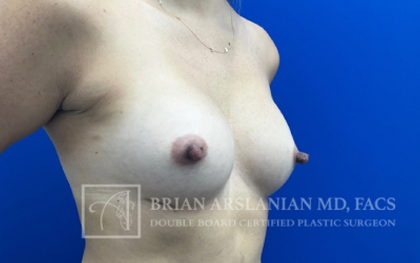 Breast Augmentation case #2747