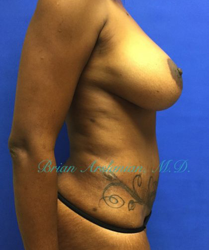 Breast Augmentation case #2508