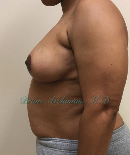 Breast Lift case #2829