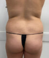 Brazilian Butt Lift case #3744